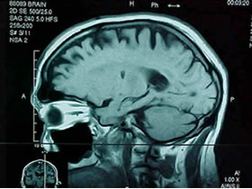 Nuevo golpe a los tumores cerebrales