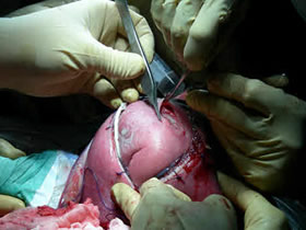 Las intervenciones quirúrgicas intrauterinas, éxito asegurado