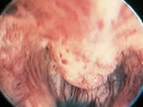 prostata
