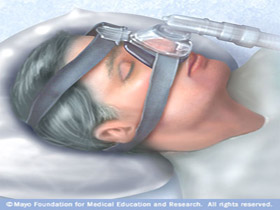 Sistema de Presion Continua (CPAP)
