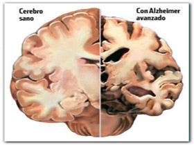 alzheimer