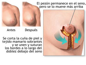 mamoplastia