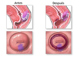 cancer-cuello-uterino_image003