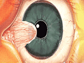 pterigium