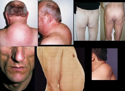 lipodistrofia