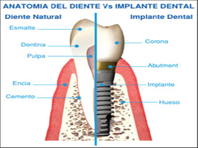 implantes