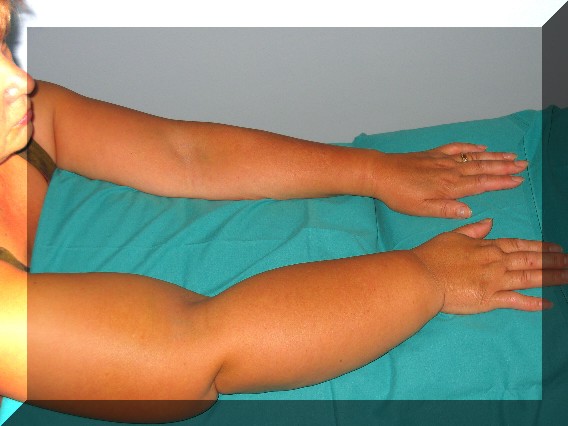 linfedema201