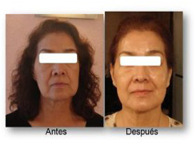 luz pulsada ok