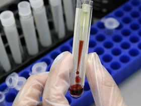 analisis-sangre-cancer-colon
