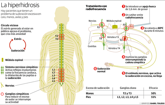 hiperhidrosis-info