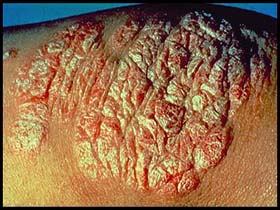 psoriasis