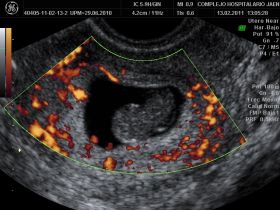ABORTO_ESPONTANEO_RETOCADO