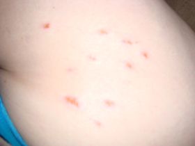 LUPUS_RETOCADO