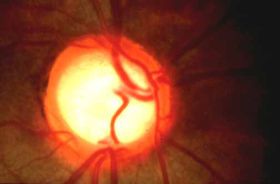 GLAUCOMA_RETOCADO