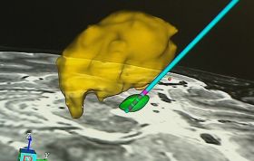 IMPLANTACION ELECTRODO RET