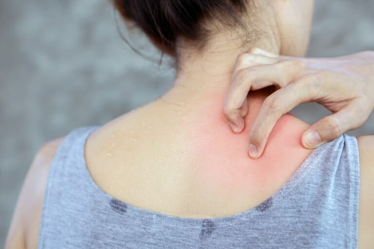 Alergia al sudor: Síntomas y mejores tratamientos
