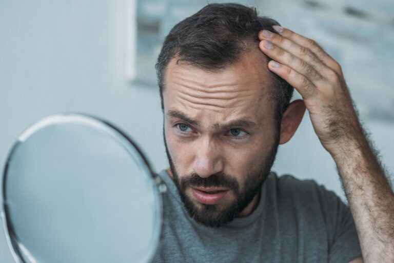 ¿Qué tener en cuenta para hacerse un injerto capilar?