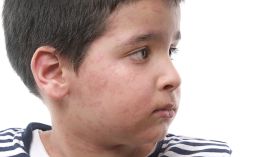 El 20 por ciento de los menores de 7 años es atópico