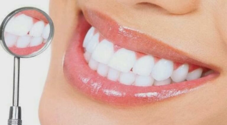 Diez consejos que debes saber antes de un blanqueamiento dental
