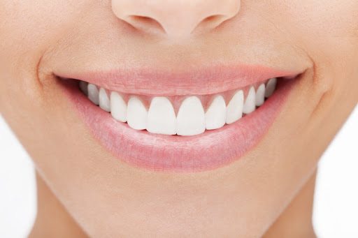 ¿Cuándo usar carillas dentales?