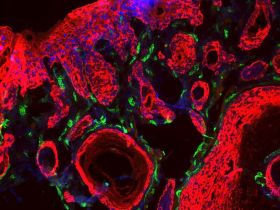 Nuevas cápsulas para tratar el cáncer de mama