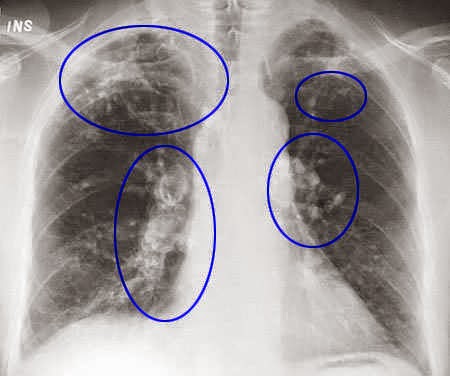 El Gobierno andaluz pone en marcha un programa integral de atención a personas afectadas por silicosis