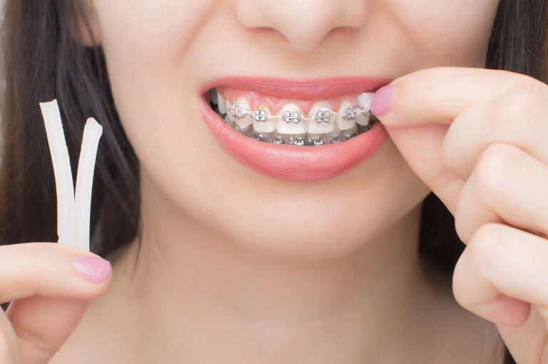 Cómo cuidar la boca con brackets