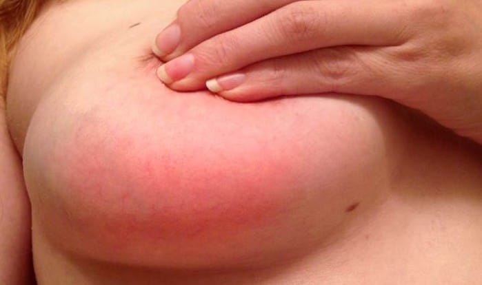 Mastitis: causas y cómo tratarlas