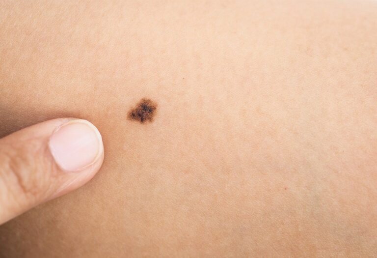 Un sensor creado por especialistas de la UGR para controlar el sol puede evitar un cáncer de piel