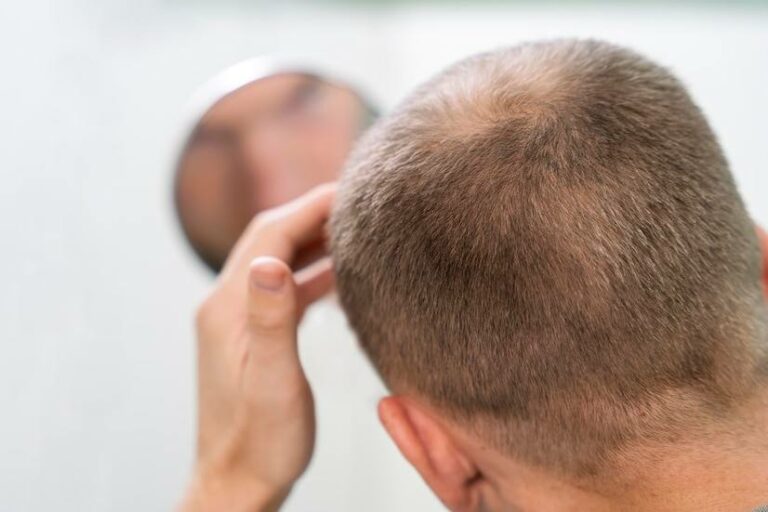 Caída inusual del cabello, ¿qué opciones tengo cómo tratamiento?