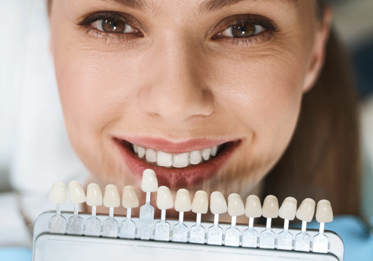 Carillas dentales: Lo que debes saber antes de visitar una clínica dental