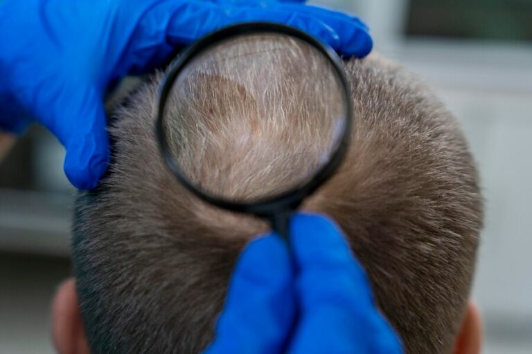 Soluciones efectivas para la caída del cabello: trasplante capilar de vanguardia