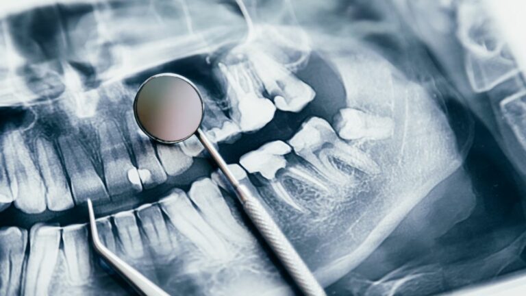 Prótesis dentales: tipos y beneficios para recuperar tu sonrisa