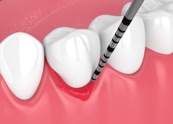 Tratamiento periodontal: Qué es y en qué casos es necesario