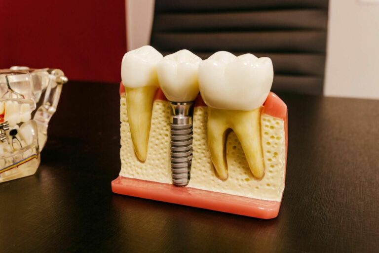 ¿Quién es la persona indicada para ponerse un implante dental?