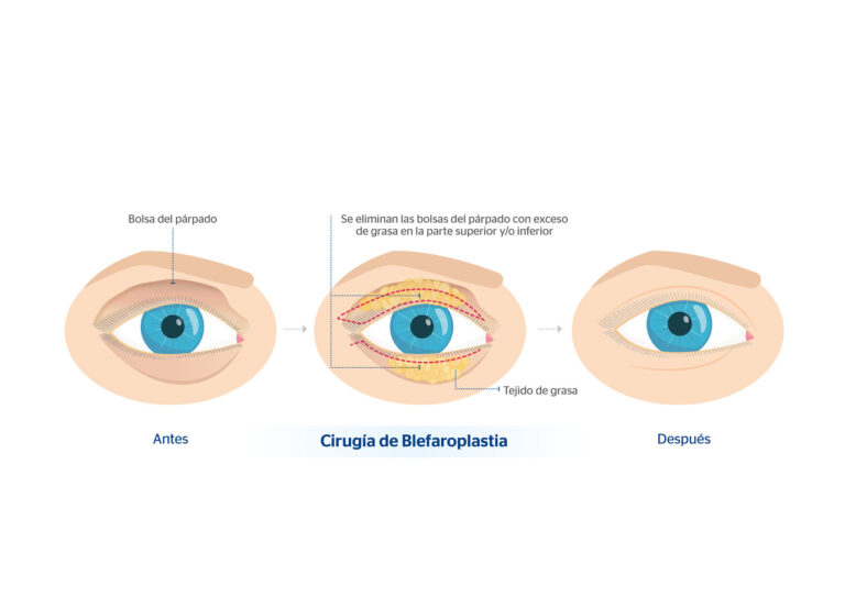 Blefaroplastia: Todo lo que necesitas saber antes de la cirugía