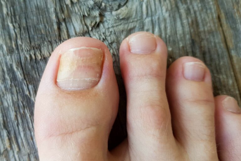 ¿Uñas dañadas por hongos o traumatismos? Descubre cómo regenerarlas y protegerlas