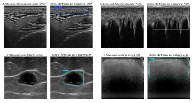 La UGR desarrolla una inteligencia artificial capaz de identificar rellenos estéticos con ecografía