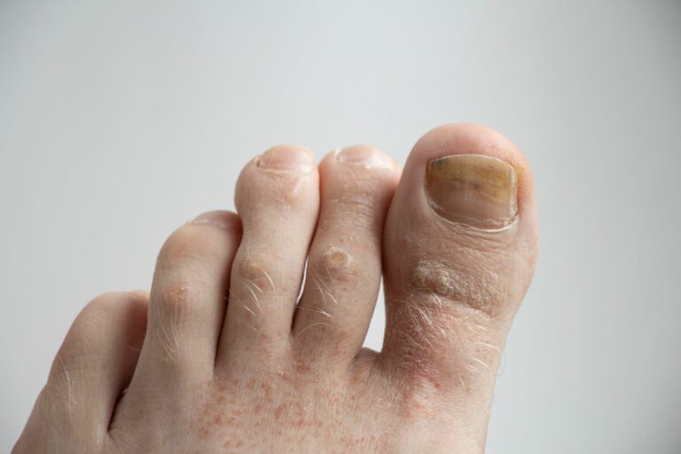 Salud podológica: la importancia de un diagnóstico temprano en dermatología